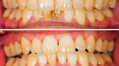 Gainesville Dental Arts Gainesville Haymarket Cosmetic Restorative Implant Bonding Dentistry Before and After