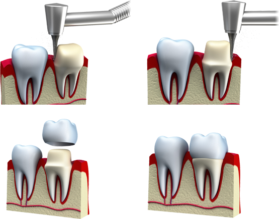 Gainesville Dental Arts Dental Crown Procedure